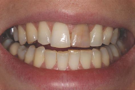 Teeth Color Changes: An In-Depth Look at Dental Health and Discoloration