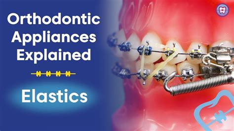 The Advantages of Orthodontic Appliances