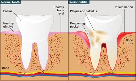 The Basics of a Inflamed Dental Tissue