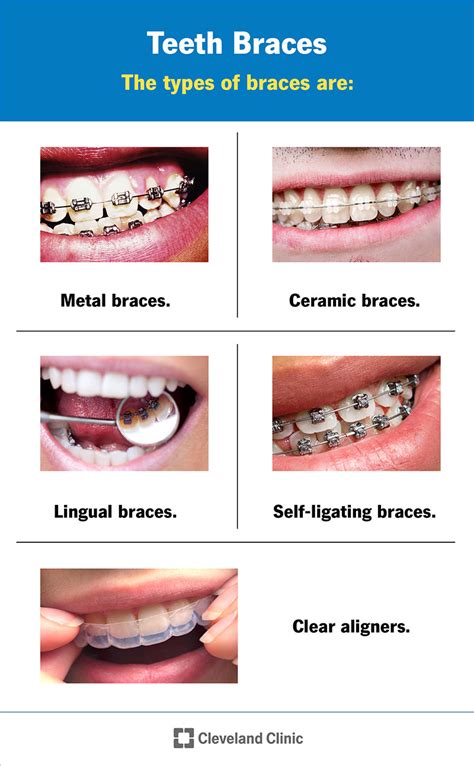 The Different Types of Braces: Choosing the Best Option for You