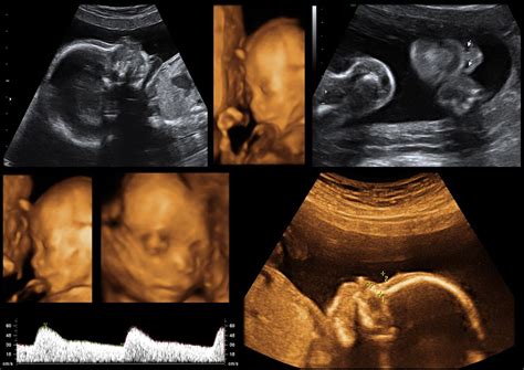The Evolution of Prenatal Imaging: From 2D to 4D Ultrasound