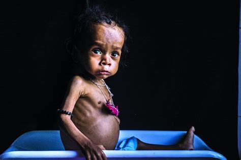 The Grim Reality of Undernourished Children