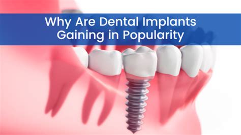 The Growing Popularity of Dental Implants: Why More and More Individuals are Choosing this Oral Solution