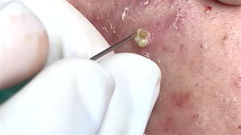 The Perils of Pimple Extraction: Unveiling the Hazards and Ramifications