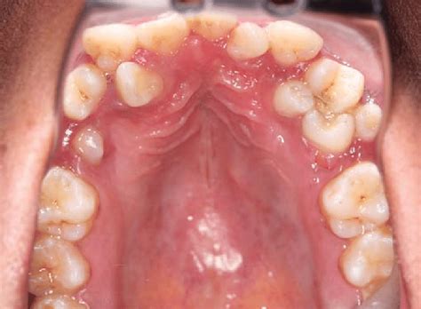 The Phenomenon of Developing Supernumerary Teeth