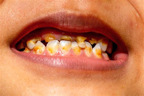 The Possible Significance of Dreaming about Broken or Decaying Milk Teeth