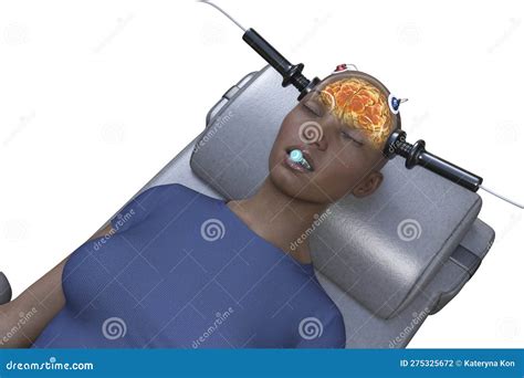 The Potential of Electroconvulsive Therapy: Exploring Electrical Stimulation Treatment within Dreams