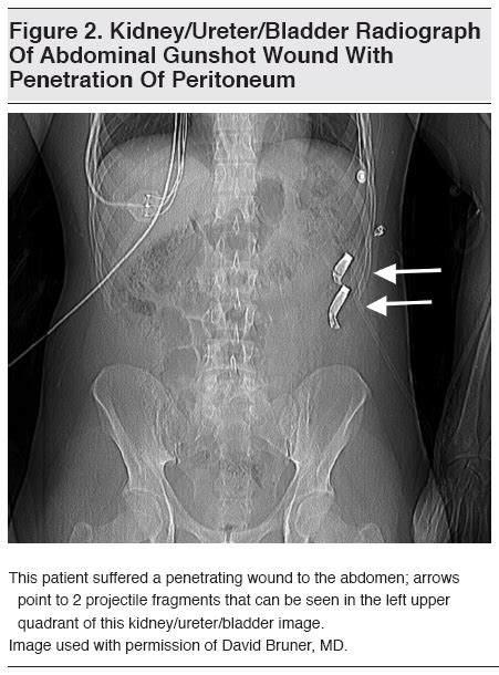 The Role of Fear and Anxiety in Dreams of Abdominal Gunshot Wounds