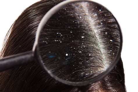 The Role of Scalp Hygiene in Dandruff Prevention