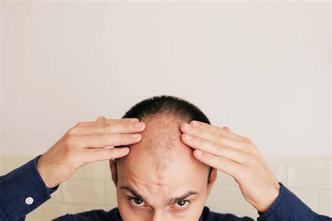 The Science Behind Hair Loss