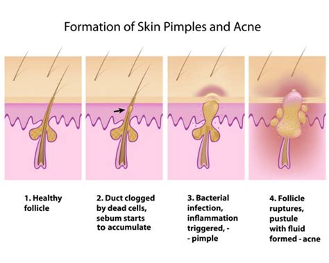 The Science Behind Pimple Formation: Understanding the Factors