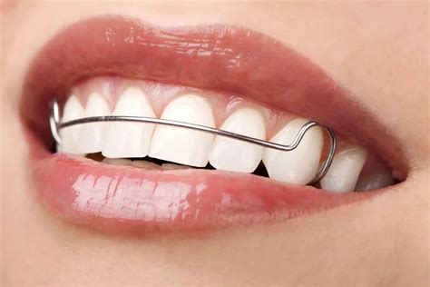 The Significance of Retainers in Orthodontic Treatment