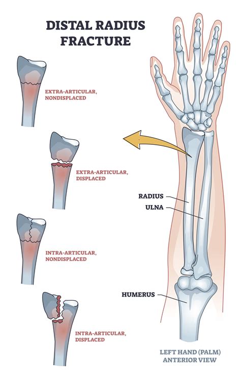 The Significance of a Fractured Left Hand in the Realm of Dreams