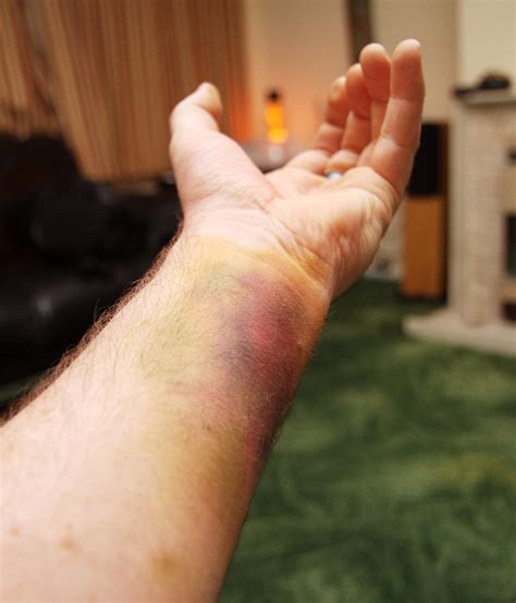 The Symbolic Power of Dreams: Exploring the Significance of a Bruised Wrist