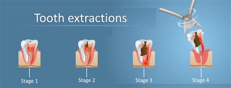 The Symbolic Significance of Extracting a Link from Your Oral Cavity