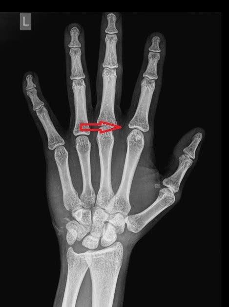 The Symbolism of a Fractured Forefinger: A Comprehensive Overview