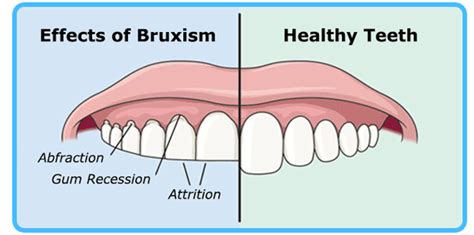 The Unconscious Clench: A Hidden Phenomenon of Bruxism