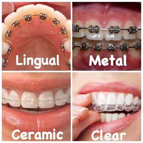 The Various Types of Orthodontic Appliances