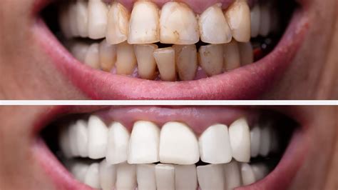 Tips for Enhancing Dental Wellness and Preventing Teeth Discoloration