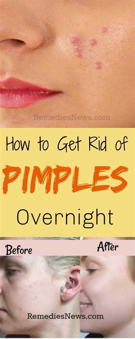 Treating Stubborn Pimples: Effective Home Remedies and Professional Options