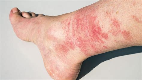 Understanding Common Triggers and Signs of Leg Rash