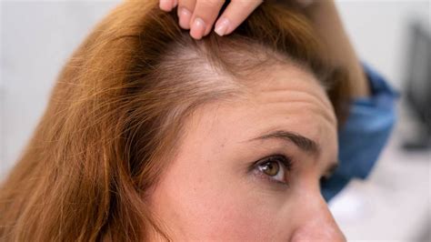 Understanding Hair Loss: What Causes the Appearance of a Bald Area in Your Dreams?