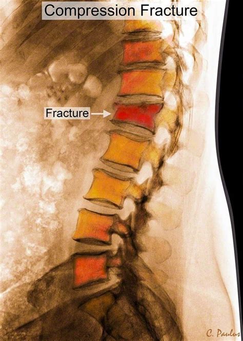 Understanding Spinal Fractures: Causes and Risk Factors