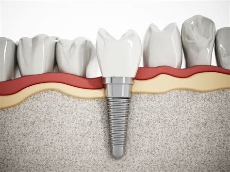 Understanding the Advantages of Fresh Dental Implants