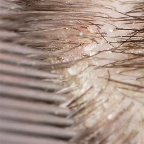 Understanding the Causes of a Dehydrated Scalp