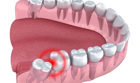 Understanding the Connection: Wisdom Tooth and Personal Growth