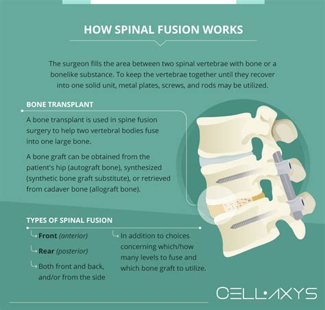 Understanding the Importance of Spinal Surgery