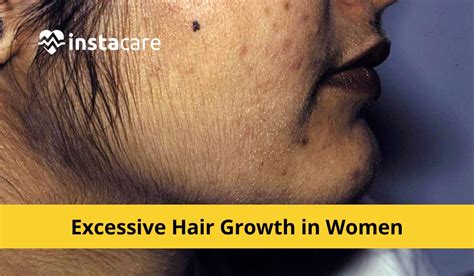 Understanding the Origins and Finding Relief from the Unsettling Experience of Excessive Hair Growth in the Throat