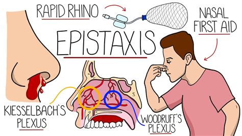 Understanding the Physiology of Epistaxis in Dreams