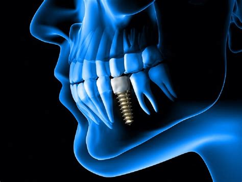 Understanding the Science Behind Dental Implants: A Closer Look at Osseointegration