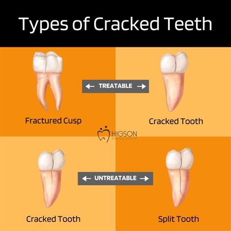 Understanding the Significance of Fracturing a Tooth in Oneiric Experiences