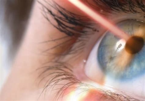 Unlocking the Advantages of Laser Eye Surgery