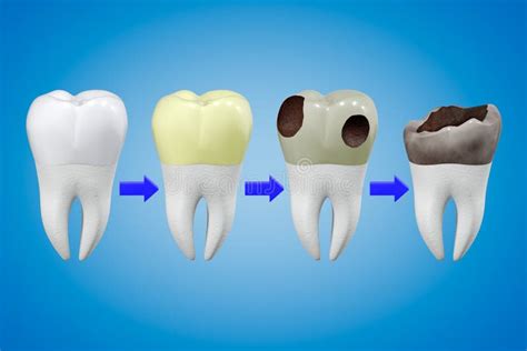 Unlocking the Significance Behind Deteriorating Tooth Fantasies