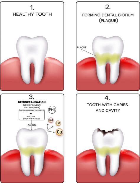 Unveiling the Link between Stress and Dental Decay