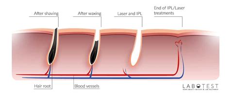 Waxing: A Popular and Reliable Hair Removal Technique