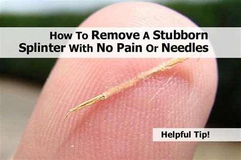 When to Seek Medical Help for Stubborn or Deep Splinters