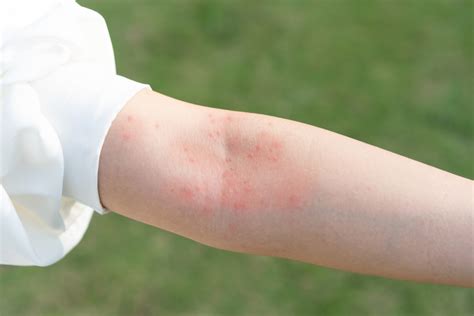 When to Seek Medical Help for Your Skin Rash